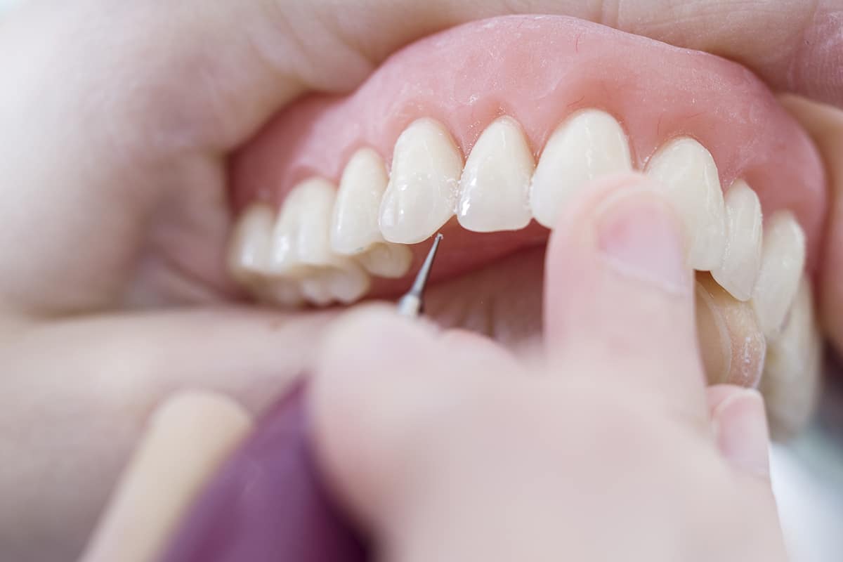 dentist inspecting same day dental implants
