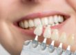 a dentist describes the difference between bonding and veneers oral procedures