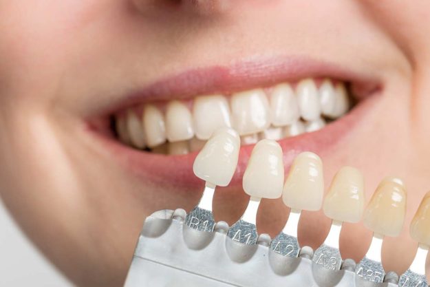 bonding, veneers a dentist describes the difference between bonding and veneers oral procedures