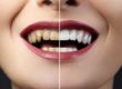before and after of dental veneers