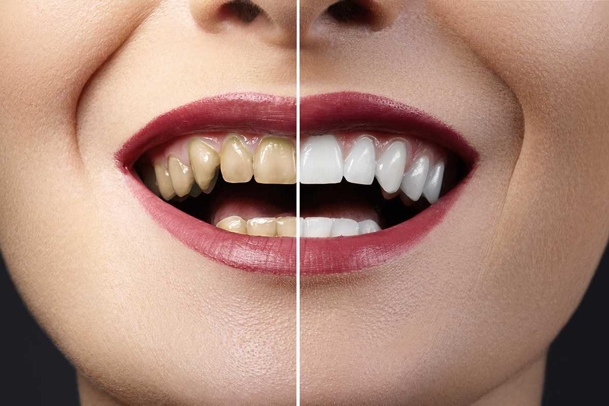 5 Benefits of Dental Veneers (1) before and after of dental veneers