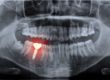 xray to show dental implants